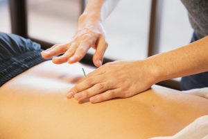 acupuncture needles on back